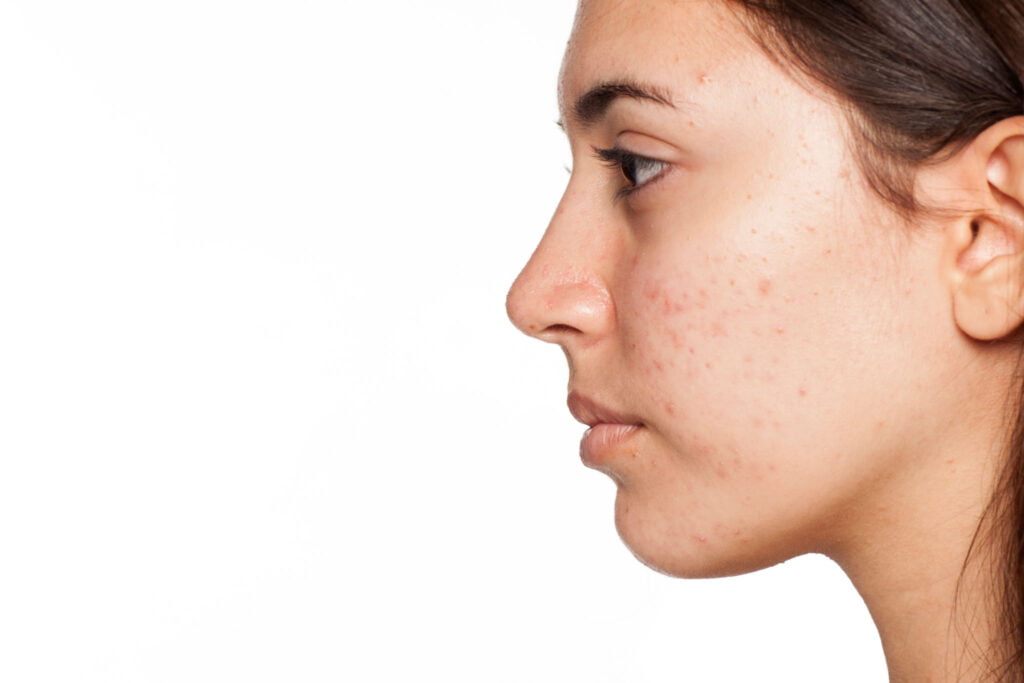 How to Get Rid of Pimples With Care How to Get Rid of Pimples With Care