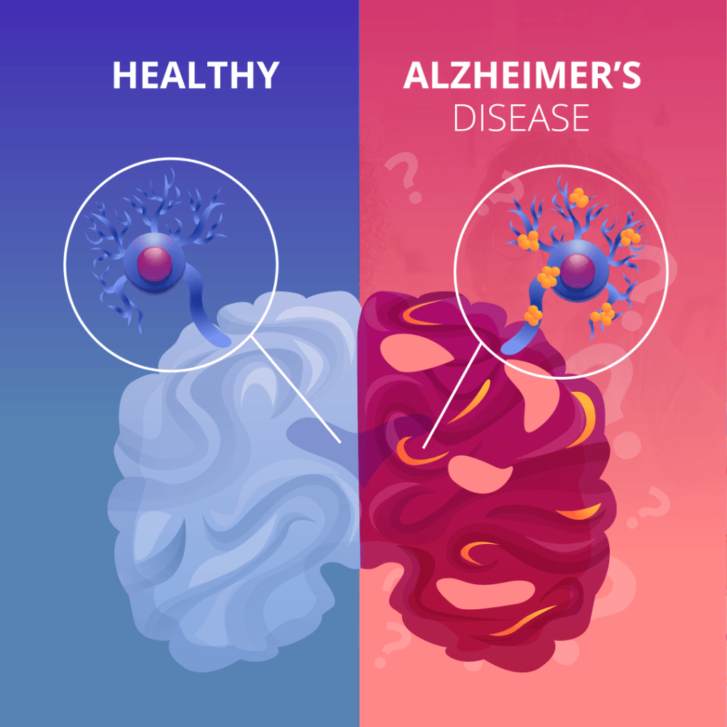 11. May Help Prevent Alzheimer's 11. May Help Prevent Alzheimer's