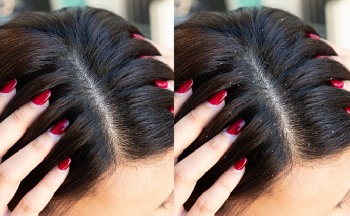 3. Help Reduce Dandruff 3. Help Reduce Dandruff