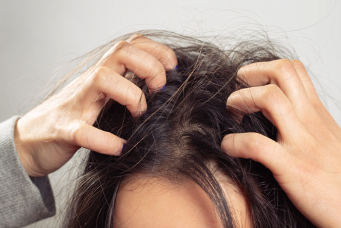4. Prevent Scalp Infections 4. Prevent Scalp Infections