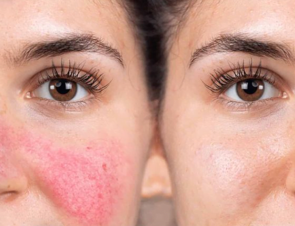 5. Reduces temporary redness 5. Reduces temporary redness