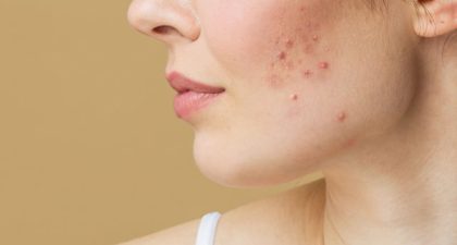 How to Get Rid of Pimples With Care